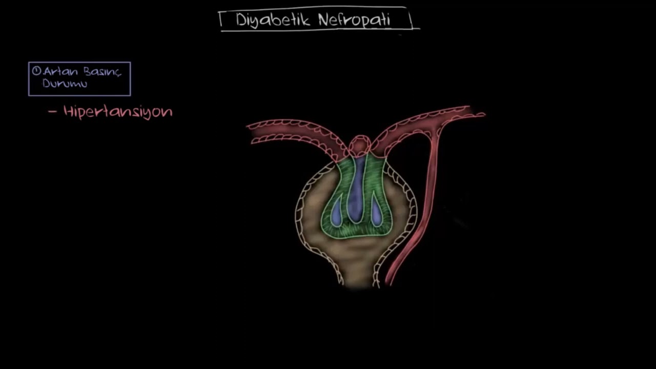 Diyabetik Nefropati: Mekanizmalar (Sağlık Bilgisi ve Tıp)