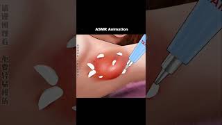 under arm fungal infection treatment asmr asmranimation viral youtubeshorts infection