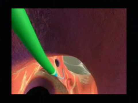 Riverside is using a new type of Pacemaker to treat congestive heart failure - YouTube