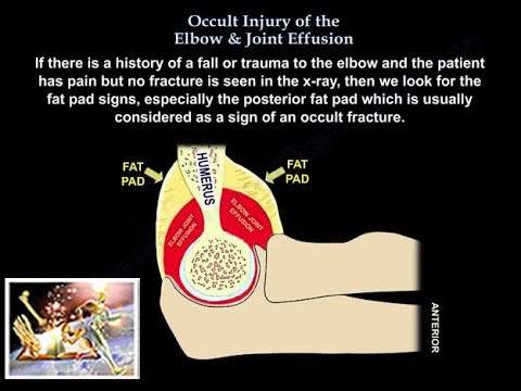 Occult Injury Of The Elbow & Joint Effusion - Everything You Need To Know - Dr. Nabil Ebraheim