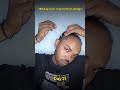 Day 21 | 180 days hair regrowth challenge #hairstyle #manmatters #hairfallsolution