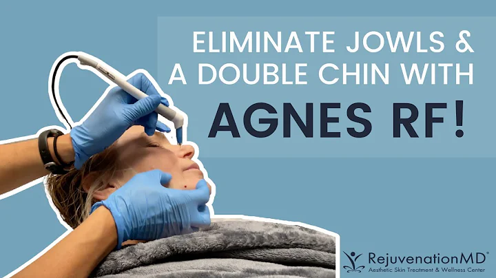 Agnes RF Treatment for Jowls and Double Chin