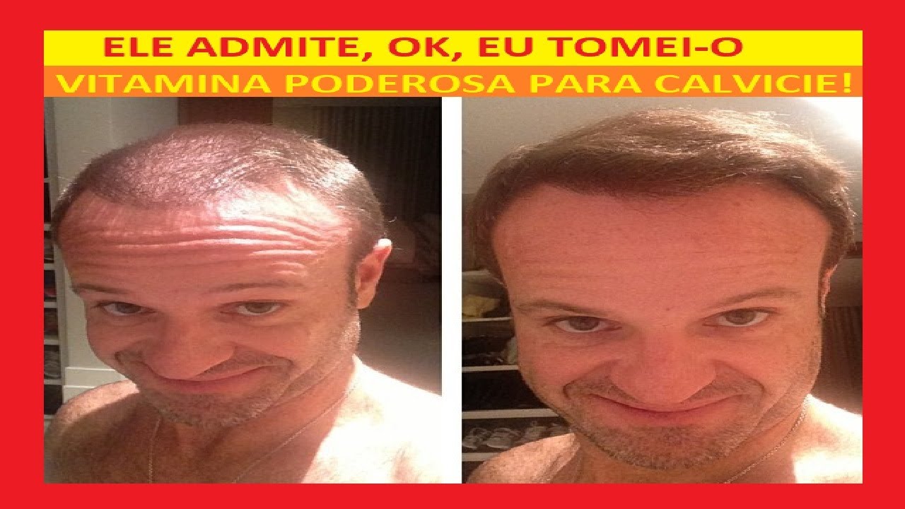 Olhos engrossar sob a óleo de pele emu os