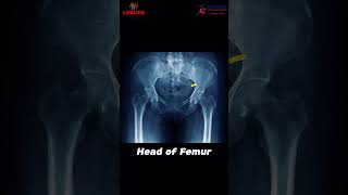 📌 Hip Fractures in the Elderly: The 2 Key Types