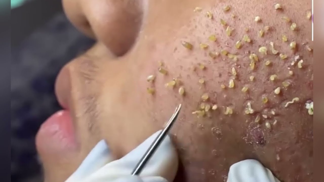 Unbelievable Extraction of Giant Blackheads - YouTube