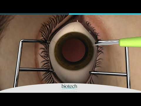 Eyecryl PHAKIC IOL Range Loading & Implantation