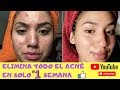 Como eliminar el Acné en solo 3 días muy efectivo