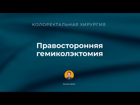 Правосторонняя гемиколэктомия