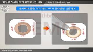 [Demonstration] d0005abko Discharge Education for Pediatric Patients with Ileostomy