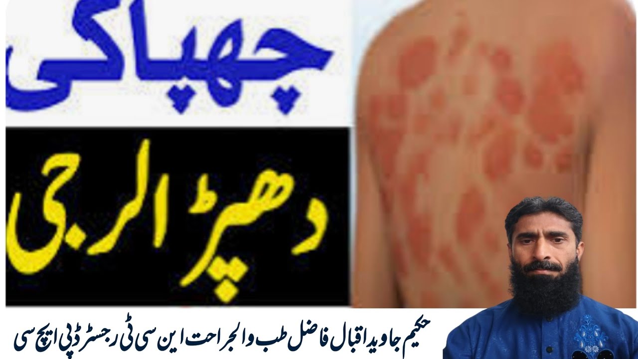 Pakistan Rash Urticaria/ Hives Treatment / چھپاکی / دھپڑ/ خارش/ جلد پر سرخ نشان اسباب ...