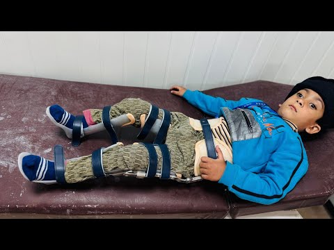 I Provided HKAFO To a Child : HELPING Him To WALK Again | Hip Knee Ankle Foot Orthosis