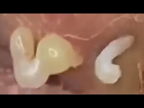 Deep blackhead extraction Cystic acne & pimple popping #32