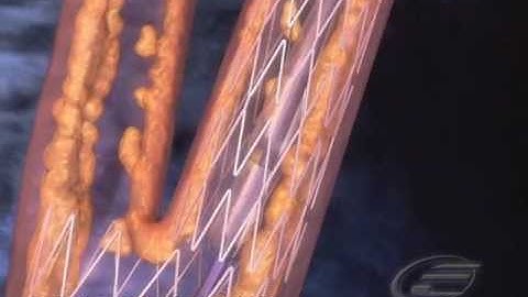 Bifurcated Coronary Artery Stent - Medical & Scientific Video Production