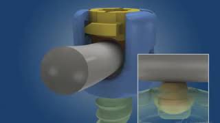 Surgalign (RTI) (Pioneer Surgical): Quantum Spinal System Polyaxial Screws and Locking C