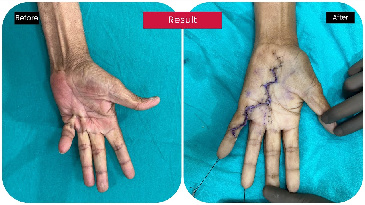 Dupuytren s Contracture Surgery YouTube