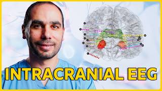 Intracranial EEG, SEEG and Brain Grids: How Do We Find Exactly Where Seizures Start