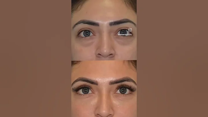 Before & After Under Eye Filler