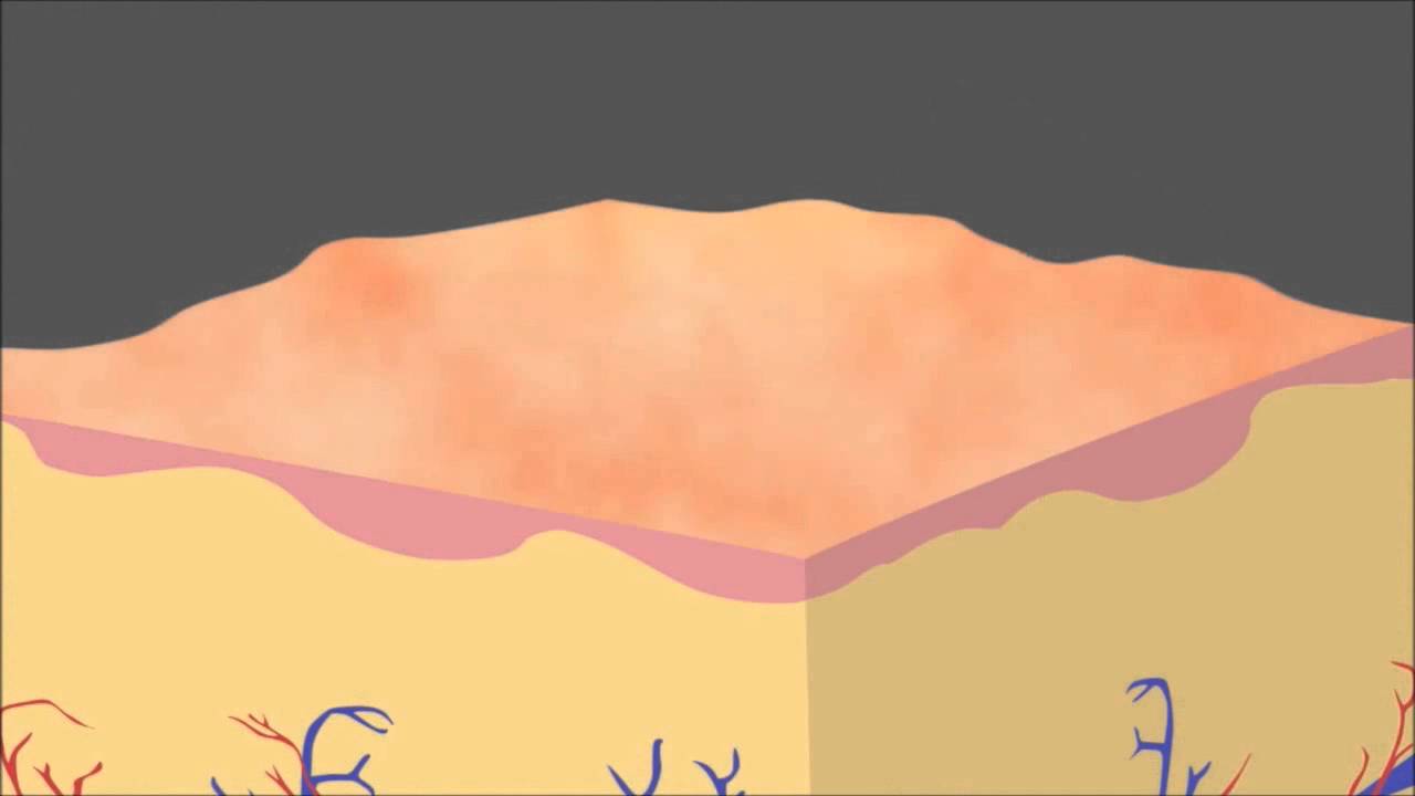 Picosure Focus Laser - Non-Surgial Laser Rejuvenation in Plano and Dallas Texas