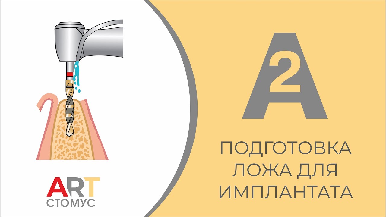имплантаты а2. имплантаты а2. протез ankylos мостовидный. имплантаты а2. имплантаты medent.