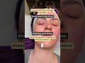 EXION Face #eternawellnessmd #peoriawellness