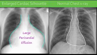 Chest x-ray  - Pericardial Effusion