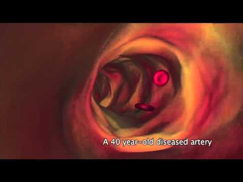 What is atherosclerosis ?