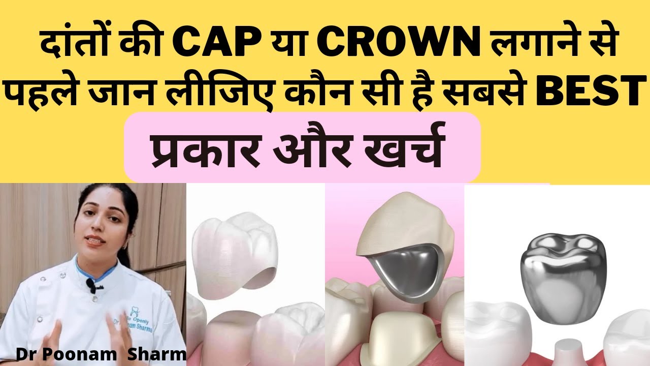 दांतो के कैप और क्राउन के प्रकार और खर्च Types And Costs Of Dental