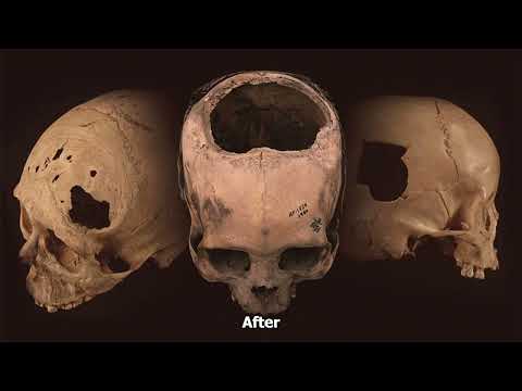 5,000-Year-Old Russian Skull Offers Evidence Of Brain Surgery Made With Stone Scalpel