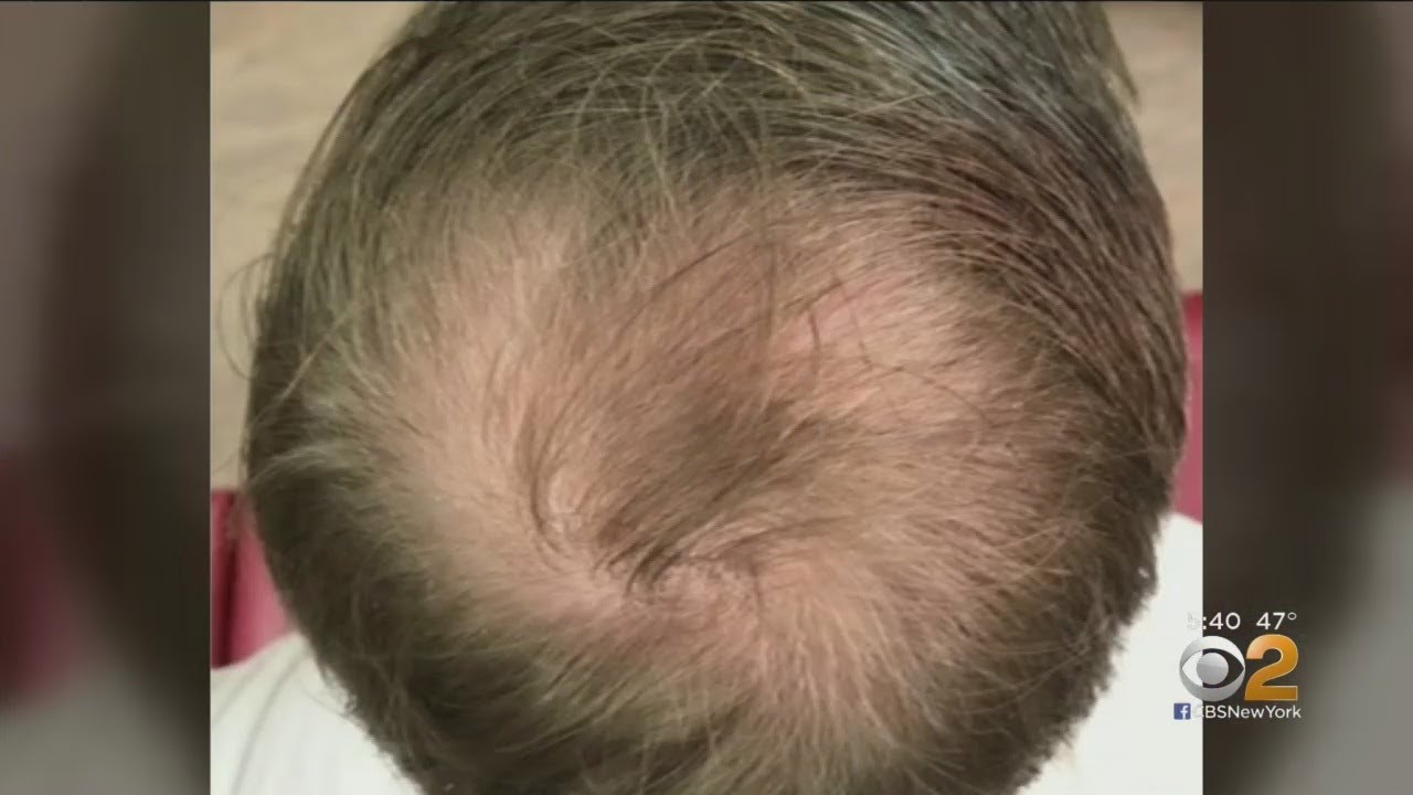 How to Use PlateletRich Plasma for Hair Growth  Warren J Bleiweiss MD PA