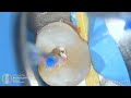 In the video The E heater #ObturationSystemDownPack from Fanta is used！
