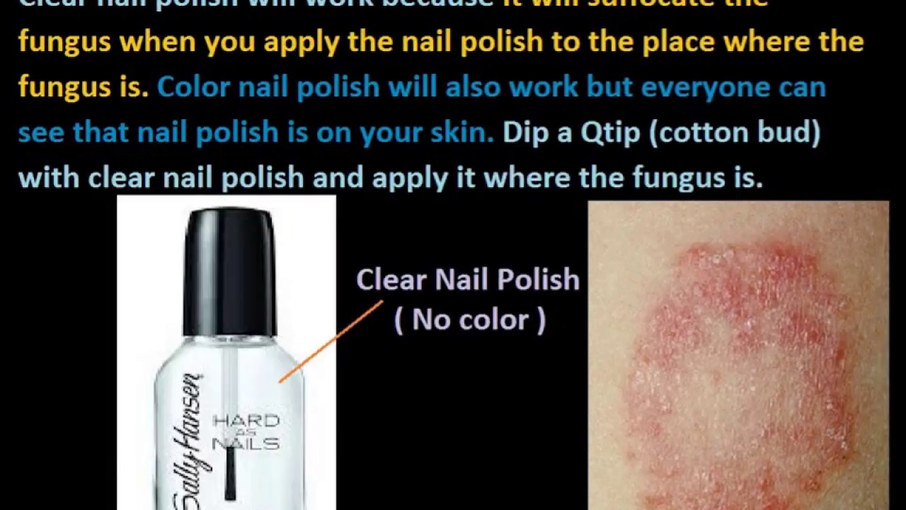 Clear Nail polish is the cure for Ringworm / Ring fungus on your skin