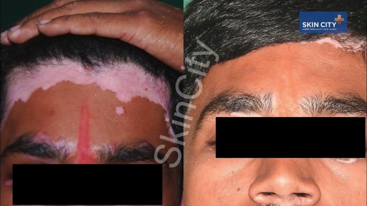 Safe & Effective Vitiligo Laser Treatment Dr. Niteen Dhepe SkinCity