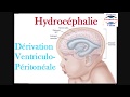 Hydrocphalie et drivation ventriculopritonale du liquide crbrospinal