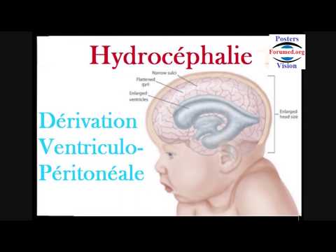 Vidéo: Hydrocéphalie Modérée - Causes, Symptômes Et Traitement