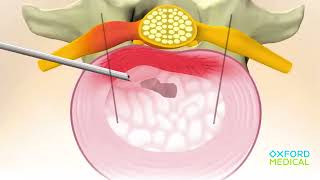 Лікування протрузій міжхребцевих дисків