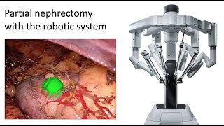 Robotic partial nephrectomy
