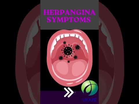 Video: De ce îmi continuă herpangină?