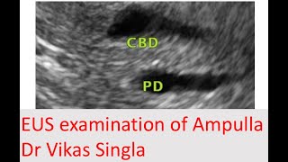 Learning video for EUS: EUS examination of Ampulla