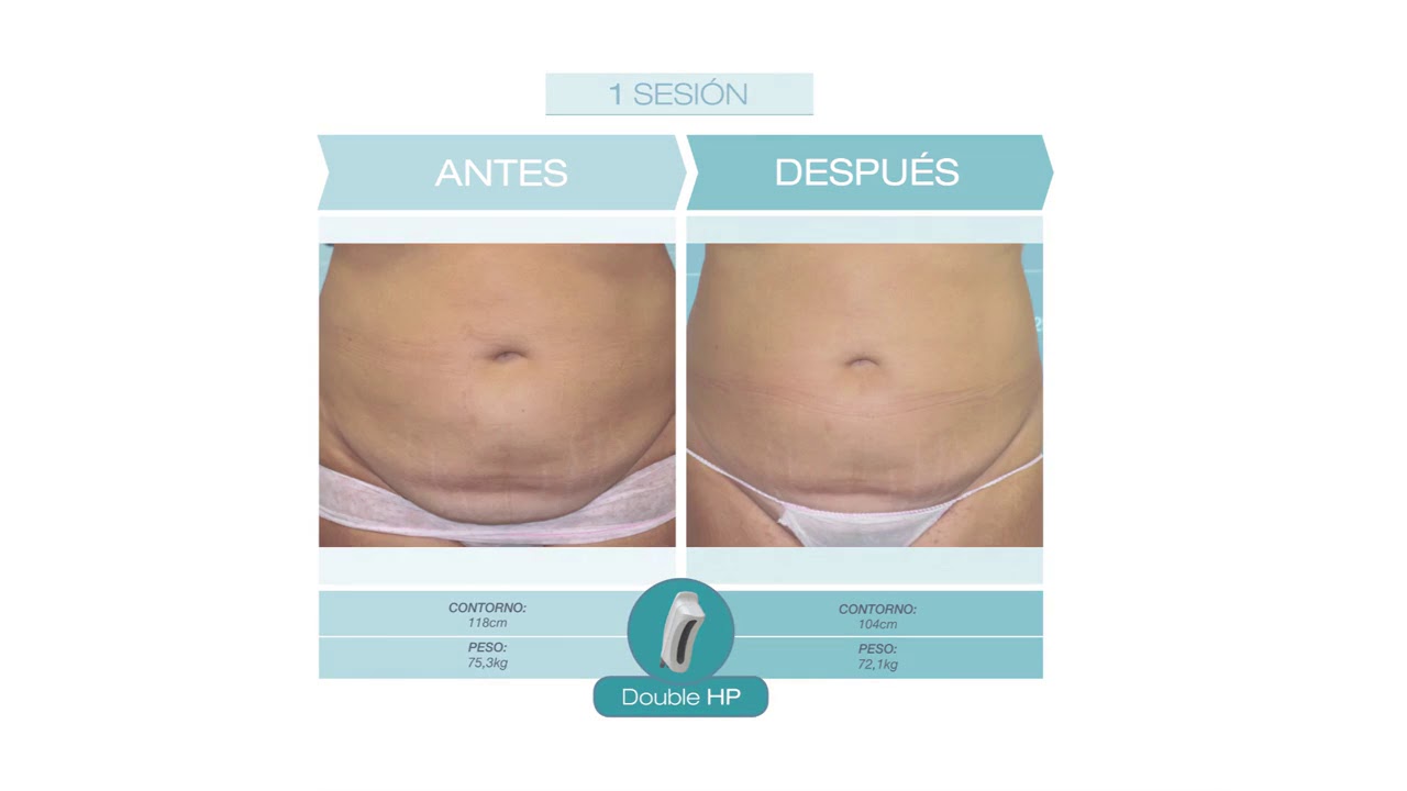 Criolipolisis opiniones