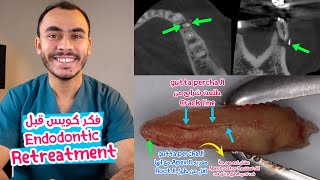 CBCT in Endodontic Retreatment