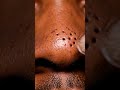 Hard ASMR Nose Blackhead Removal | Extreme Macro #asmr #blackheadcaique #satisfying #skincare