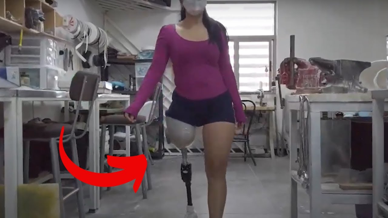 Эпизод 81 Валерия с протезом ноги выше колена.