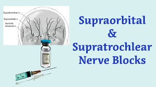 Anesthesia Technique for Blocking the Supraorbital and Supratrochlear Nerves