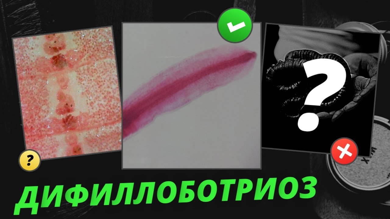 ДИФИЛЛОБОТРИОЗ: симптомы, причины, диагностика и лечение / Жизненный Цикл Diphyllobothrium latum