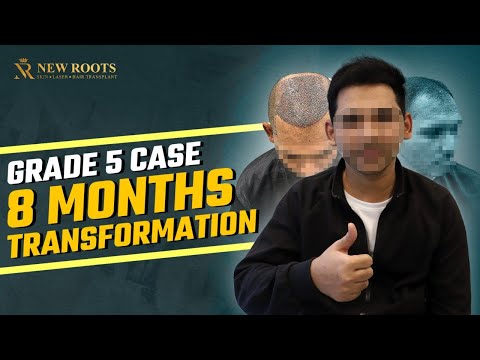 Baldness Gone, Confidence Back 😎 | My Hair Tranformation in Nagpur | New Roots