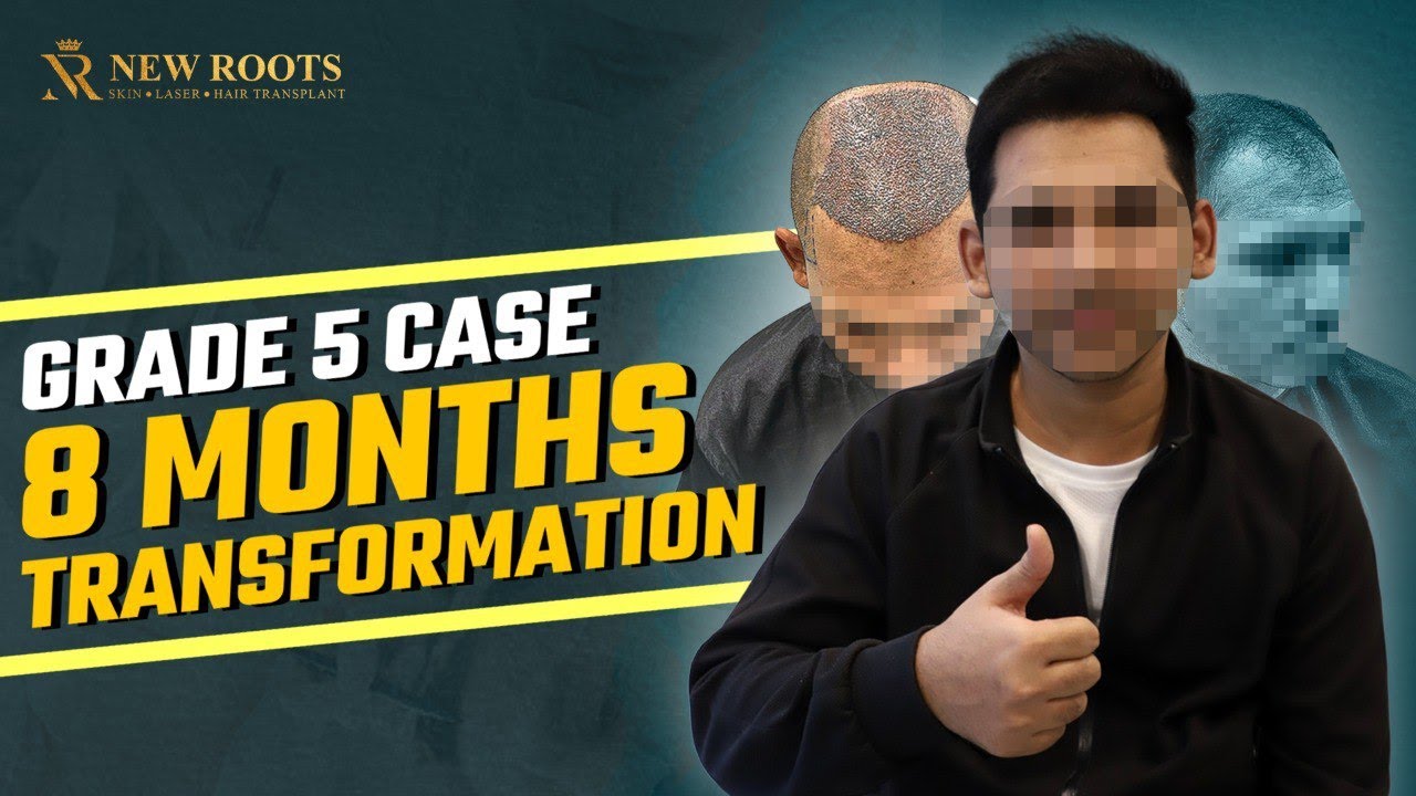 Baldness Gone, Confidence Back 😎 | My Hair Tranformation in Nagpur | New Roots