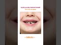 😱 Shocking ‘Rampant caries’ for 7 yr old patient #kidsdentistry #hyderabaddentist #hyderabad #trend