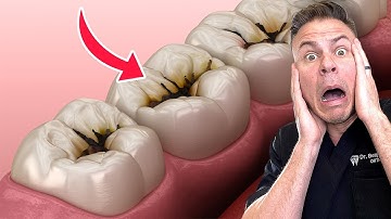 Is It Possible To NEVER Get Cavities Without Brushing?!