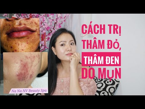 Trị Thâm Đỏ, Thâm Đen Do Mụn Đúng Cách