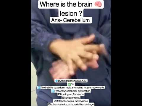 Dysdiadochokinesia Mbbs Next